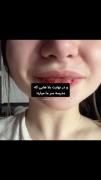 عوارض استرس مدرسه بر سلامت جسمانی دانش آموزان: جوش، ریزش مو و لب‌های ترک‌خورده